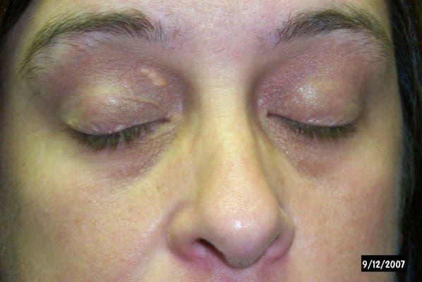 Xanthelasma โ soft yellow cholesterol plaques on the eyelids
