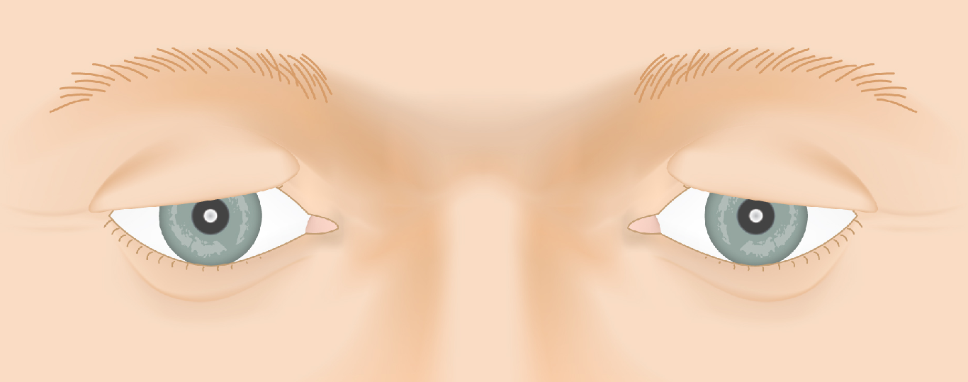 Blepharoplasty — Pre/Post Comparison — slide 1 of 6