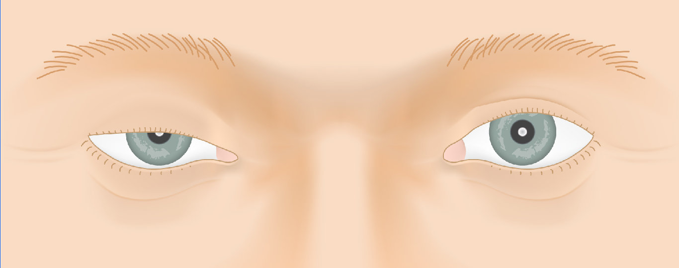Ptosis — Hering's Law Visualization — slide 1 of 5