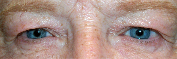 Dermatochalasis — excess upper eyelid skin hooding over the lashes