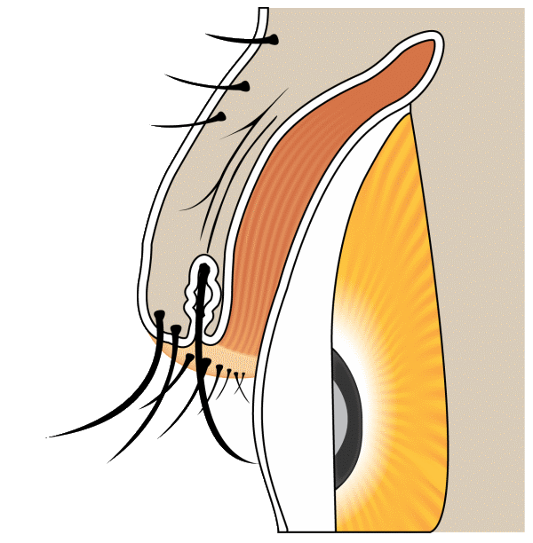 Diagram: distichiasis with a second row of lashes from meibomian gland orifices