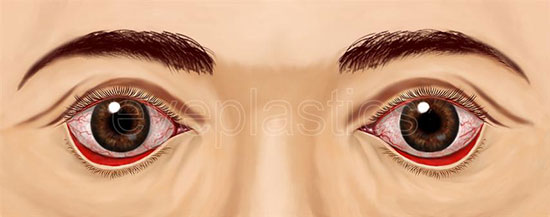 Clinical photograph of lower eyelid ectropion with outward turning of the lid margin