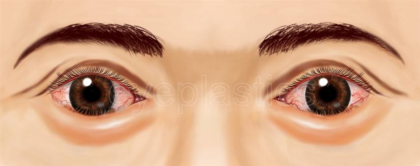 Clinical photograph of lower eyelid entropion with inward rolling of the lid margin and lashes