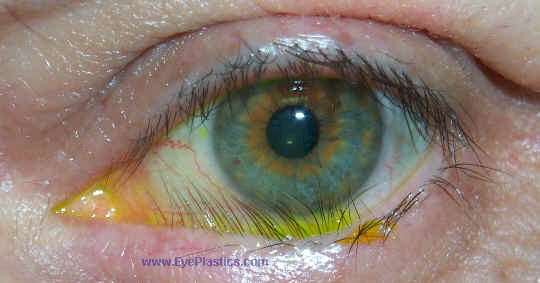 Clinical photograph of trichiasis with eyelashes misdirected toward the corneal surface