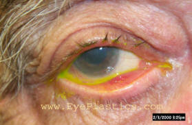 Ectropion showing outward turning of the lower eyelid away from the eye