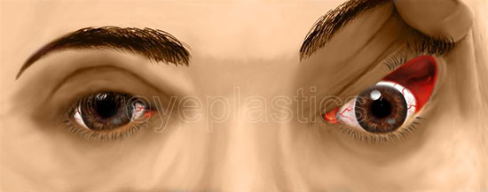 Floppy eyelid syndrome demonstrating effortless eversion of the rubbery upper eyelid