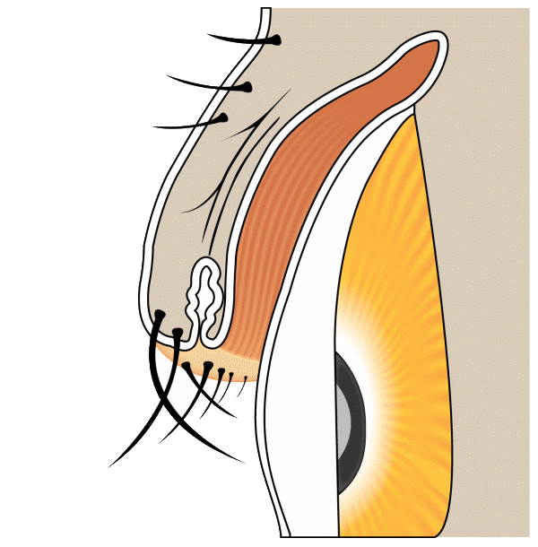 Diagram: trichiasis with lashes directed toward the cornea