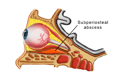 Diagram of orbital and subperiosteal abscess