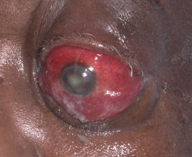 Orbital cellulitis with marked periorbital erythema, edema, and proptosis
