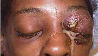 Orbital infection — clinical photograph showing severe proptosis and periorbital swelling