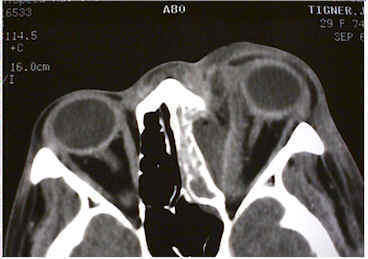 CT imaging demonstrating orbital cellulitis with adjacent sinus disease