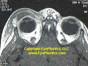 Preseptal periorbital cellulitis with eyelid swelling and erythema