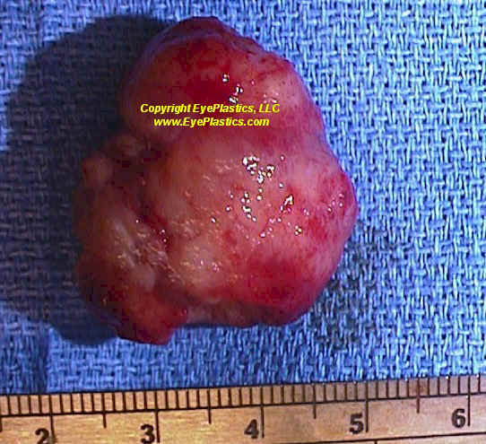Orbital hemangiopericytoma