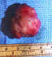 Orbital tumor causing proptosis