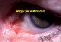 Eyelid skin tumor