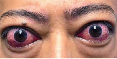 Before treatment — Age 45