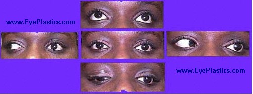 Enhance Prosthetic Eye Motility with 