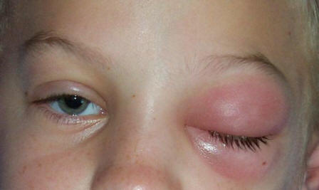 periorbital cellulitis contagious