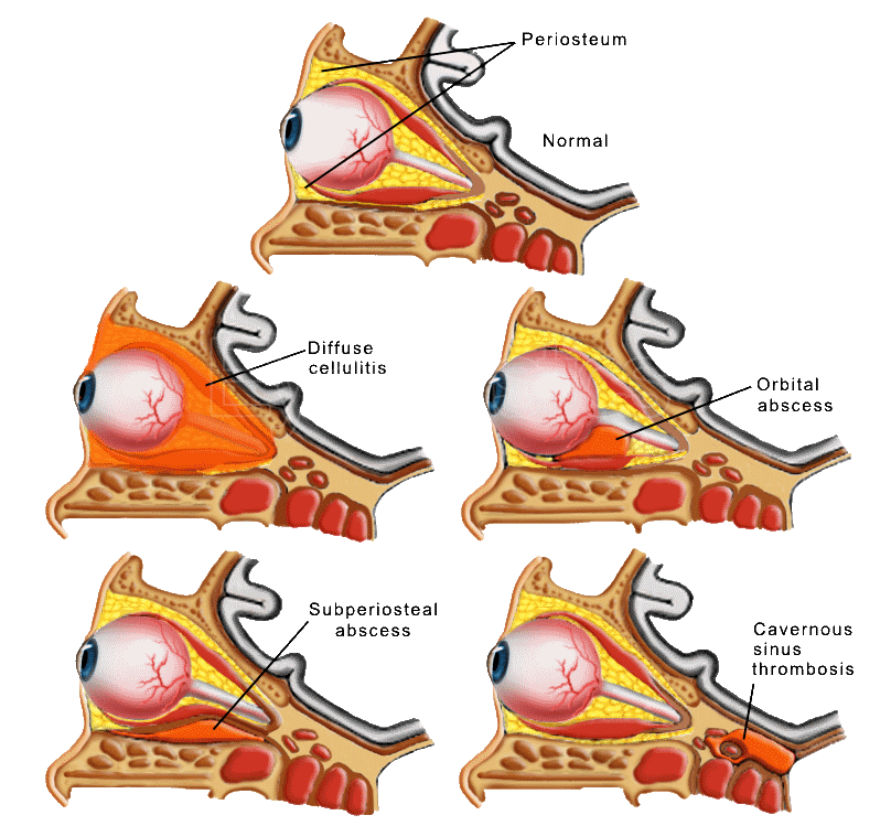 Orbital cellulitis Information