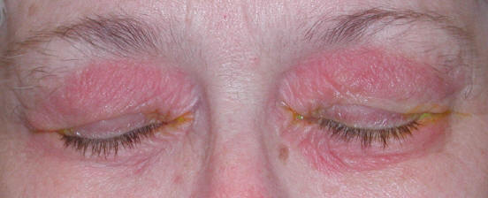 Ocular Rosacea